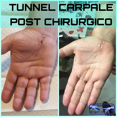 trattaemento tunnel post chirurgico.png