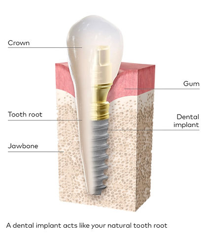 ABF Dental Implant.jpg