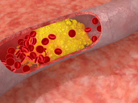 LDL Cholesterin Werte – Was Sie über das „schlechte“ Cholesterin wissen sollten
