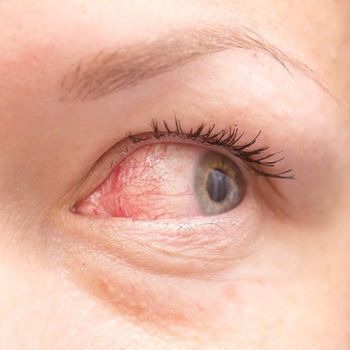 What to do if you have red eyes