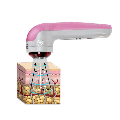 Skin Cure Ultrasound facial - Deep cleansing and skin renewal