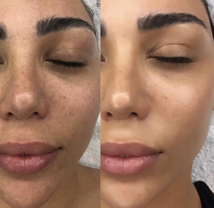 bb glow treatment near me