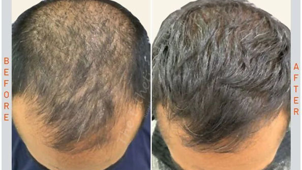 Before and after of hair transformation treatment