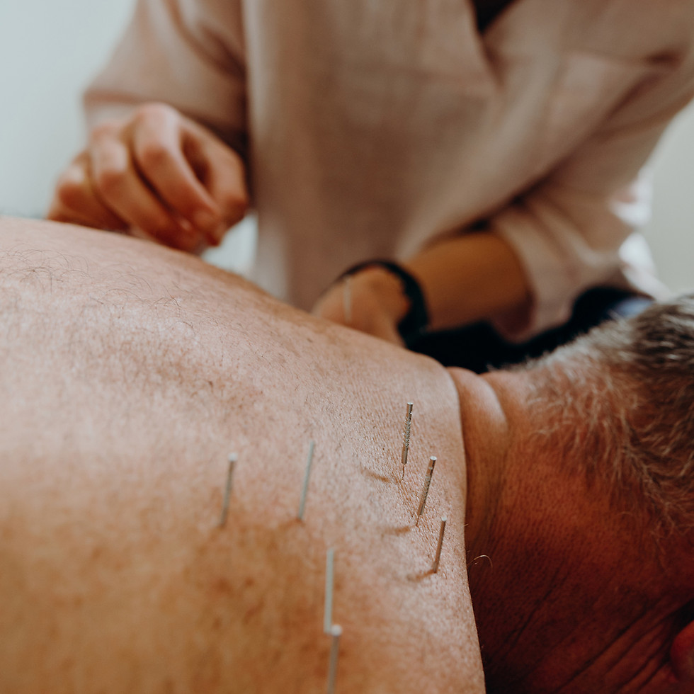 Dry Needling treatment at Discover Health Group.