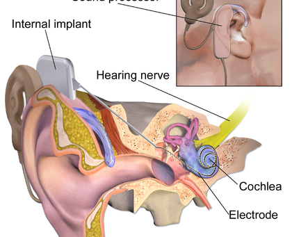 Lateef's Journey-Auditory Neuropathy Spectrum Disorder and Cochlear Implants