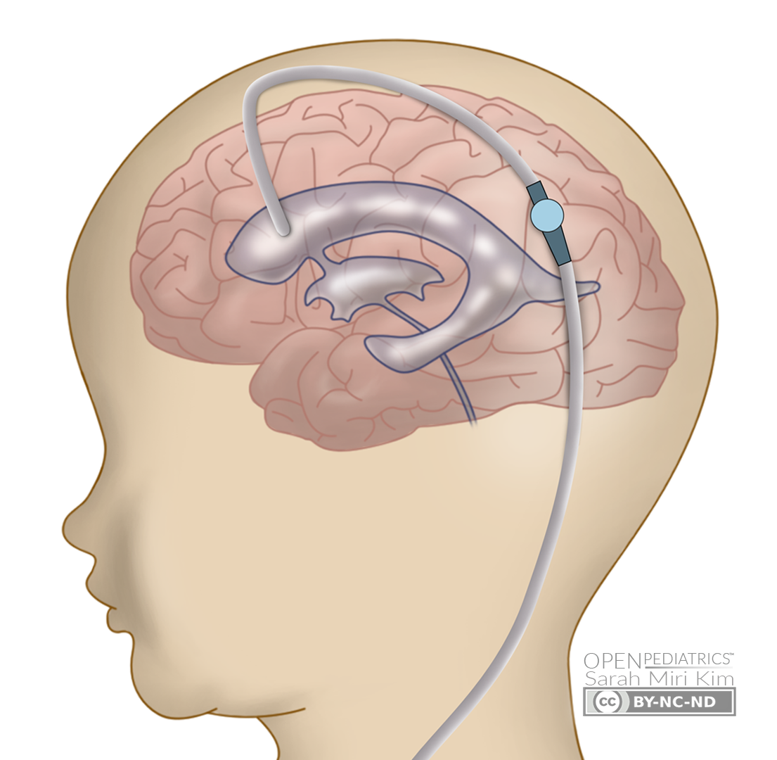 Ventriculoperitoneal Shunt