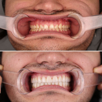 caso clínico de rehabilitación dental compleja con carillas dentales full smile - Oh My Dent!