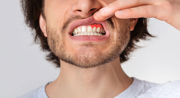 bigstock-gingival-inflammation-and-dent-370465579.jpeg