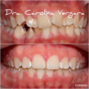 Caso Clínico de Antes y Después de un tratamiento de ortodoncia con brackets metálicos, Oh My Dent! - Clínica Dental en Viña del Mar