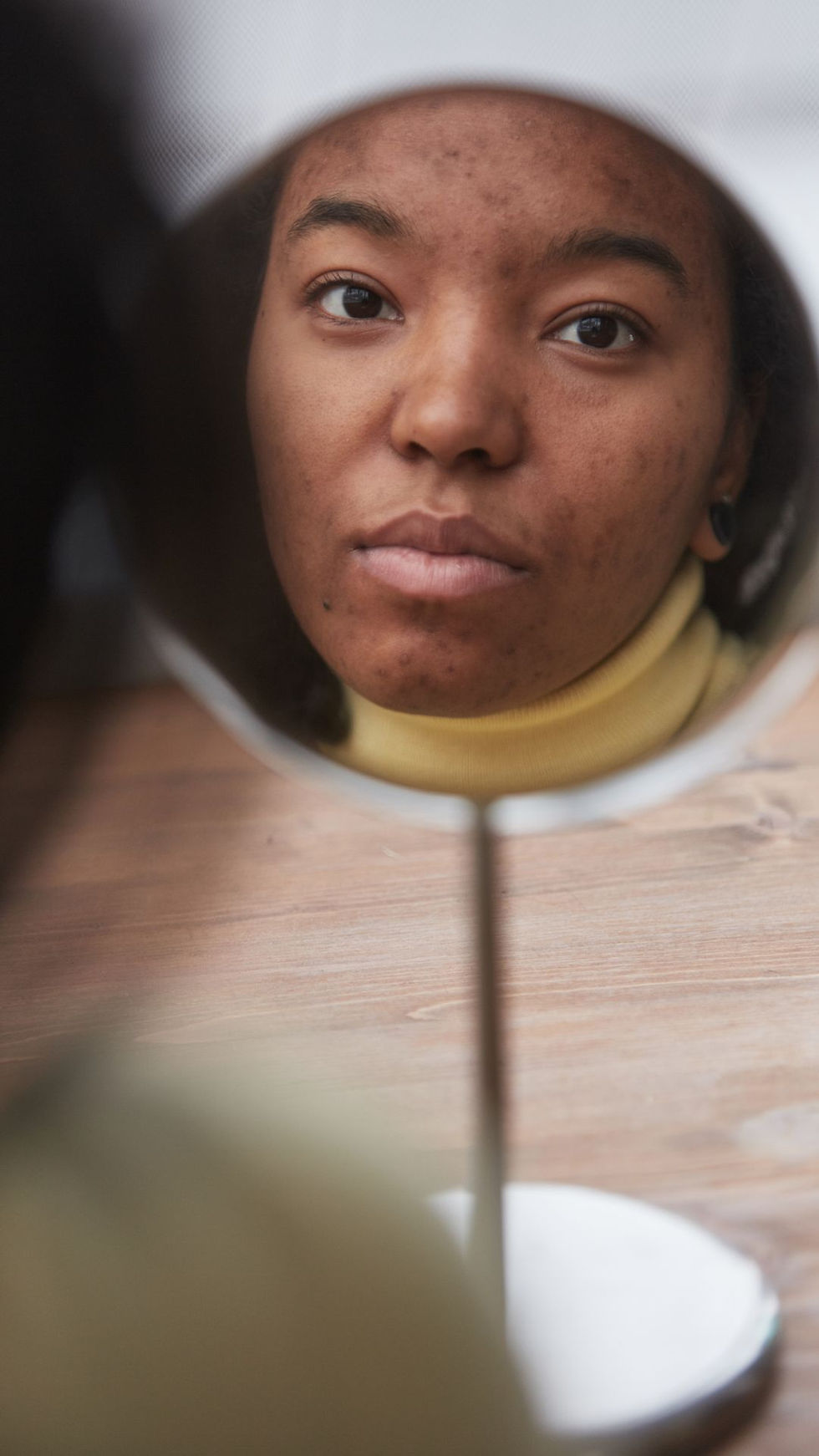 Woman with dry skin and acne looking in mirror, showing clogged pores and hyperpigmentation