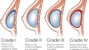 Illustration of four breast implant conditions, Grades I-IV. Blue implants vary in palpability and visibility, with red marking Grade IV.