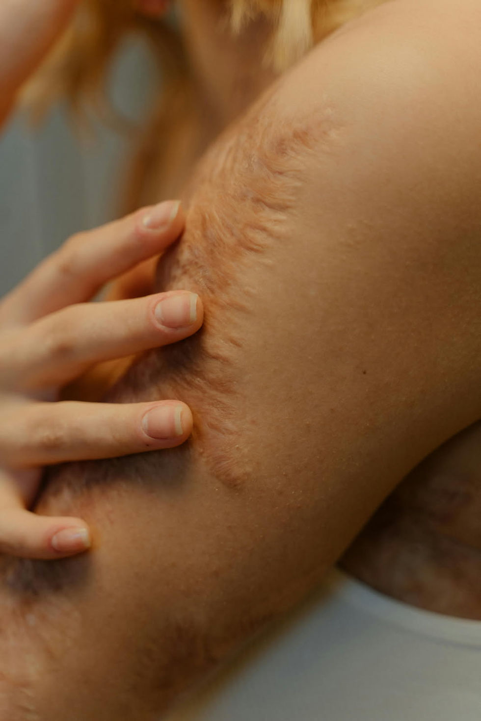 Close-up of a person gently touching a scarred arm with their hand. Warm lighting highlights the textured skin and creates a calm mood.