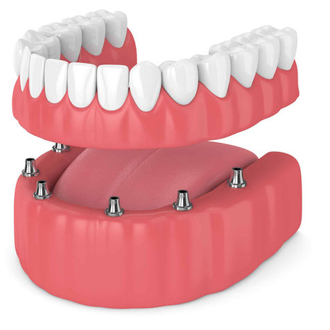 THE BENEFITS OF IMPLANT-RETAINED DENTURES IN JACKSONVILLE