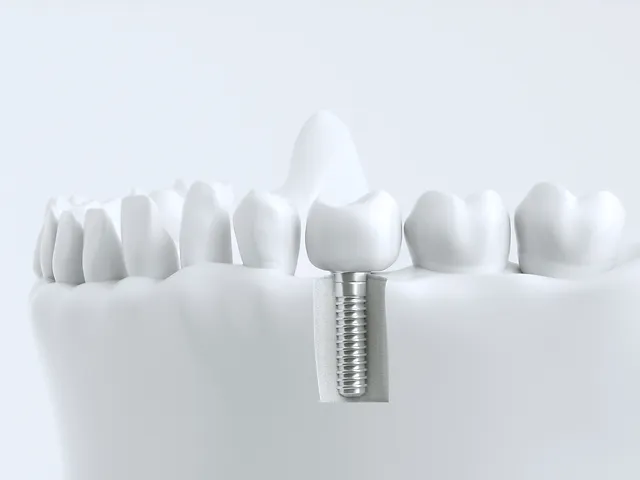 Implant Procedure First Coast Oms