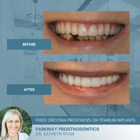 Before and After | Zirconia Prosthesis' on Titanium Implants