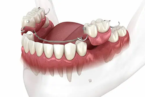 Dentures-Full-and-Partial.webp