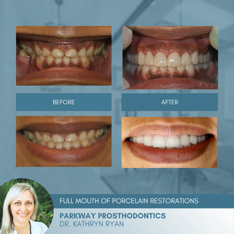 Transformation Tuesdays | Full Mouth Rehabilitation in Jacksonville, FL | Before and Afters