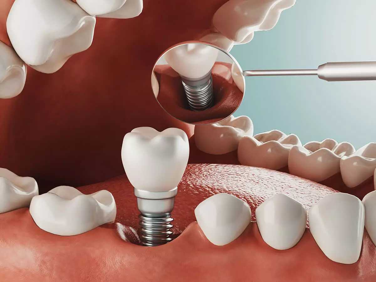Costs For Dental Implants Sarasota Florida