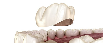 Dental Crown in Sarasota, FL