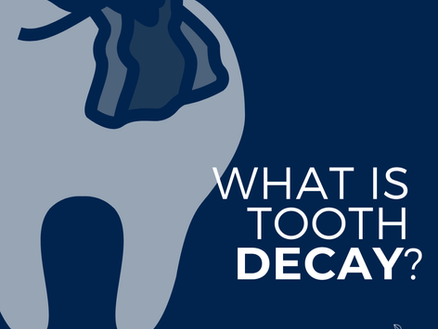 What is Tooth Decay