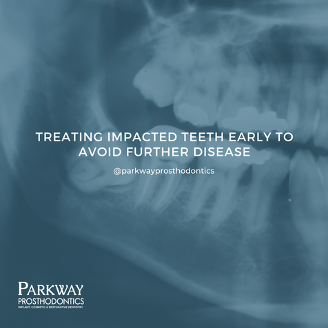 Treating Impacted Teeth Early to Avoid Disease