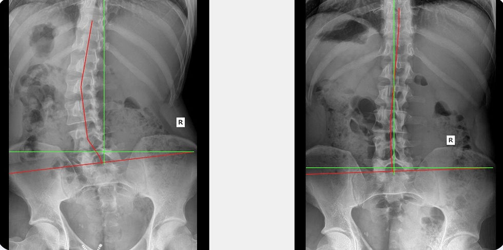 Eye-level view of a patient undergoing scoliosis treatment