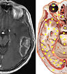 MRI. Brain tumor vs NLS