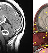 MRI. Cerebral glioma vs NLS