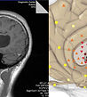 MRI. Cystic cerebral tumor vs NLS