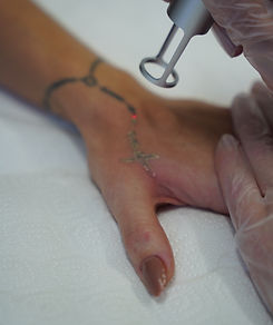 détatouage laser