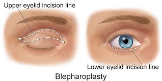 Blepharoplasty.jpg