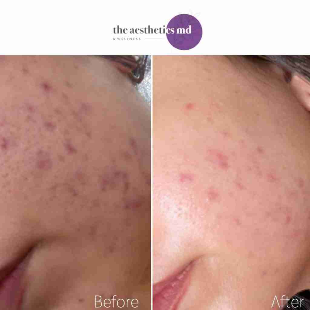 Before and After Acne Treatment with EndyMed