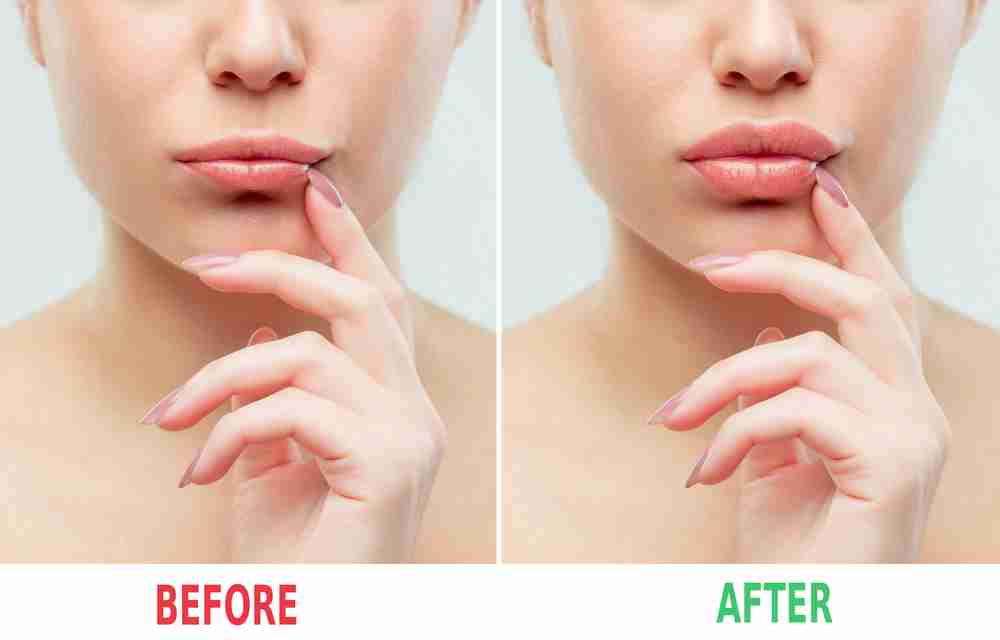 Before and after lips filler injections.