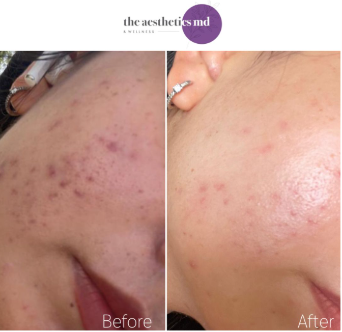 Before and After Acne Treatment with EndyMed