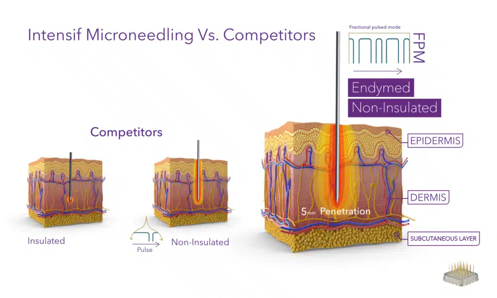 EndyMEd Skin Tightening