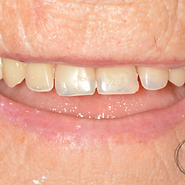An Alternative for a Loose Lower Denture?
