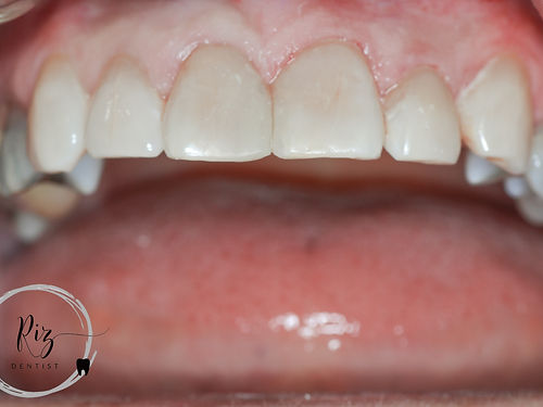 Seeking a Radiant Smile for a Special Occasion
