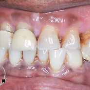 CC- full mouth rehab with partial dentures