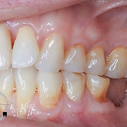 Achieving Balance: Bite Correction and Pain Relief