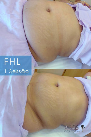 Imagem antes e depois demonstrando os resultados impressionantes do protocolo FHL da Jess Corporal, onde se observa uma redução significativa de medidas. A comparação lado a lado mostra claramente o contorno corporal mais definido e a silhueta esculpida após a massagem a quatro mãos, evidenciando a eficácia do tratamento exclusivo oferecido pela clínica.