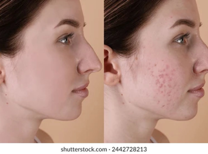 Scar repair treatment