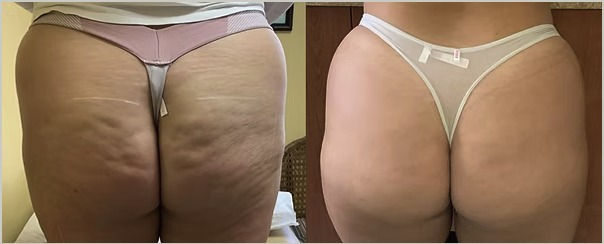 Evolve X Transform: Fat Reduction, Tightening, and Muscle Toning