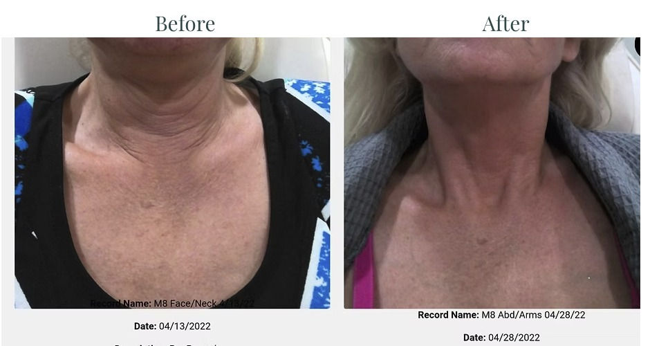 Morpheus8: Deep Skin and Fat Remodeling