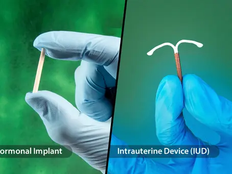 Copper T/Implants: Which Long-Term Contraception Method is Right for You?