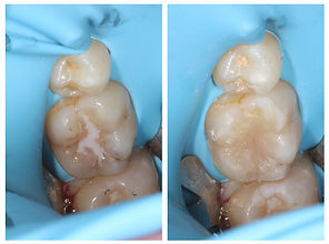 cosmetic composite white filling