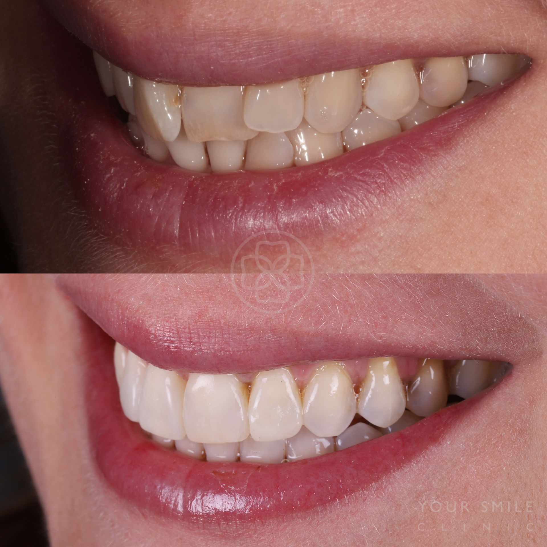 Invisalign & composite bonding
