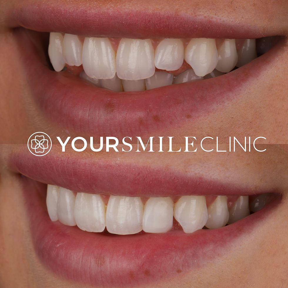 Minimally invasive smile makeover with composite bonding