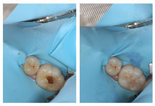 carious cavity restored with cosmetic composite white filling