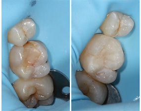 cosmetic composite white filling