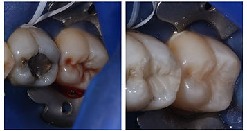 amalgam removal replaced with white cosmetic composite filling
